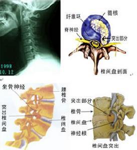 运动系统慢性损伤基本概述