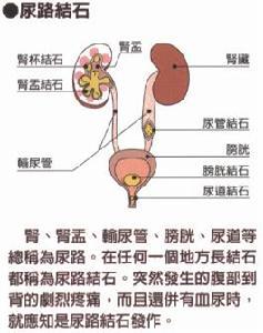 上尿路结石饮食调理