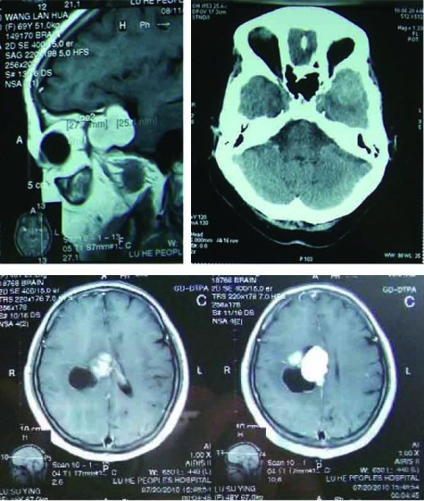 颅底肿瘤治疗原则以解剖学为基础