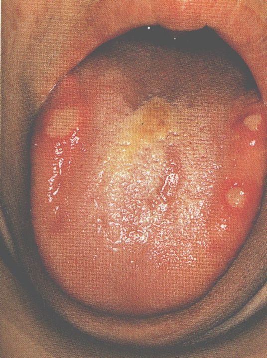 口腔单纯疱疹发病机制