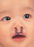 唇颚裂症状介绍唇颚裂是常见的先天性畸形