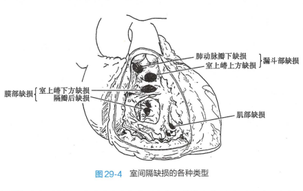 室间隔缺损病因