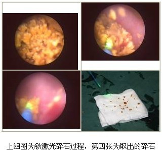 激光医疗作用激光手术