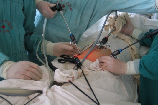 腹腔镜手术区别内容