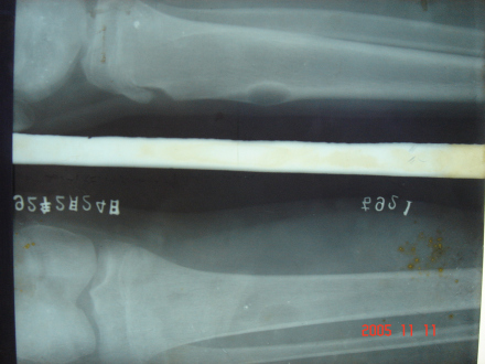 骨化纤维瘤疾病症状生长缓慢