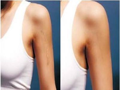 疤痕治疗疤痕定义当人体皮肤深层受到创伤后