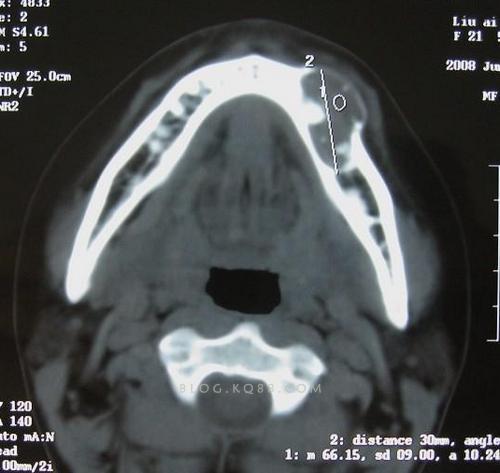 骨化纤维瘤鉴别诊断