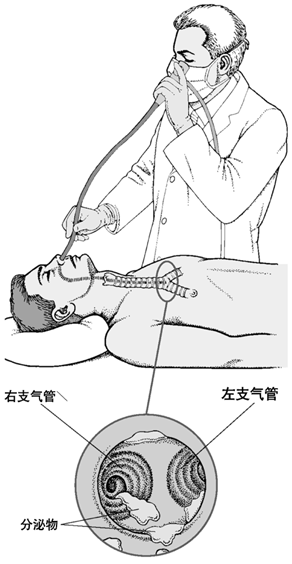 呼吸系统疾病支气管镜检查