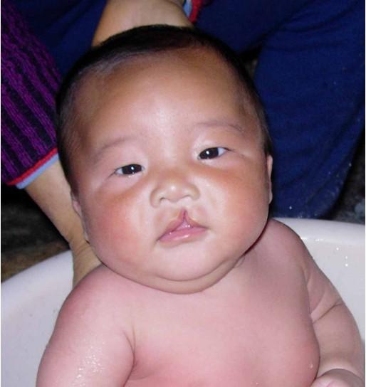 唇颚裂预防1孕妇在怀孕期间应避免偏食