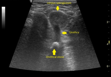 尿道结石诊断男性前尿道结石可沿着尿道触及