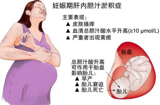 胆汁淤积治疗