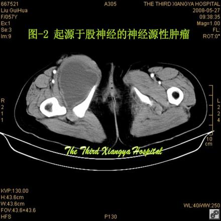 神经源性肿瘤病理生理不明