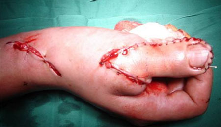 皮瓣移植基本介绍皮瓣也称带蒂移植皮肤